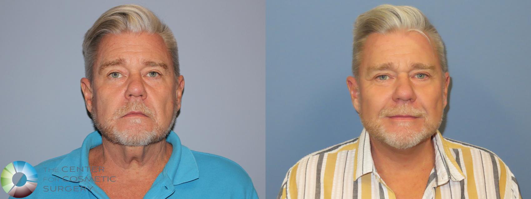 Before & After SMAS Facelift Case 12214 Front in Denver and Colorado Springs, CO