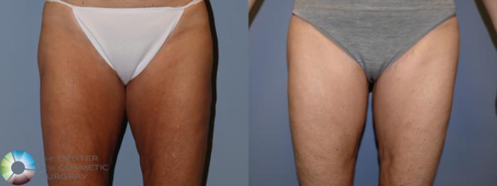 Before & After Thigh Lift Case 11865 Front in Denver, CO