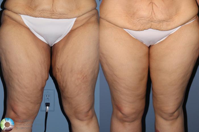 Before & After Thigh Lift Case 11866 Front in Denver, CO