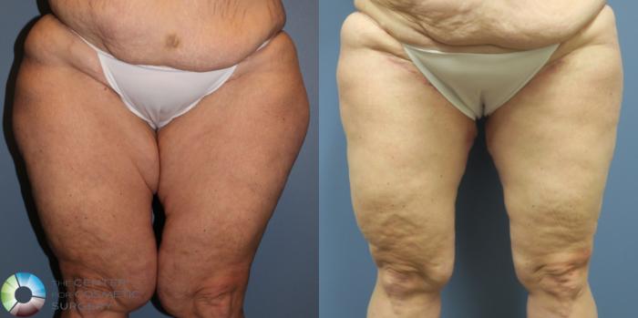Before & After Thigh Lift Case 11867 Front in Denver, CO
