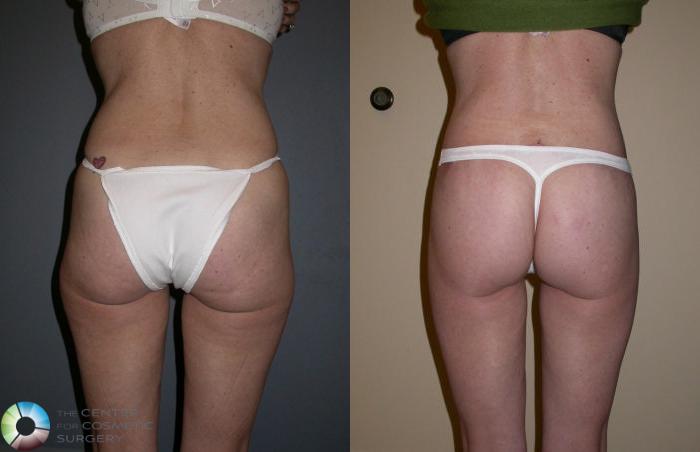 Before & After Thigh Lift Case 62 View #1 in Denver, CO