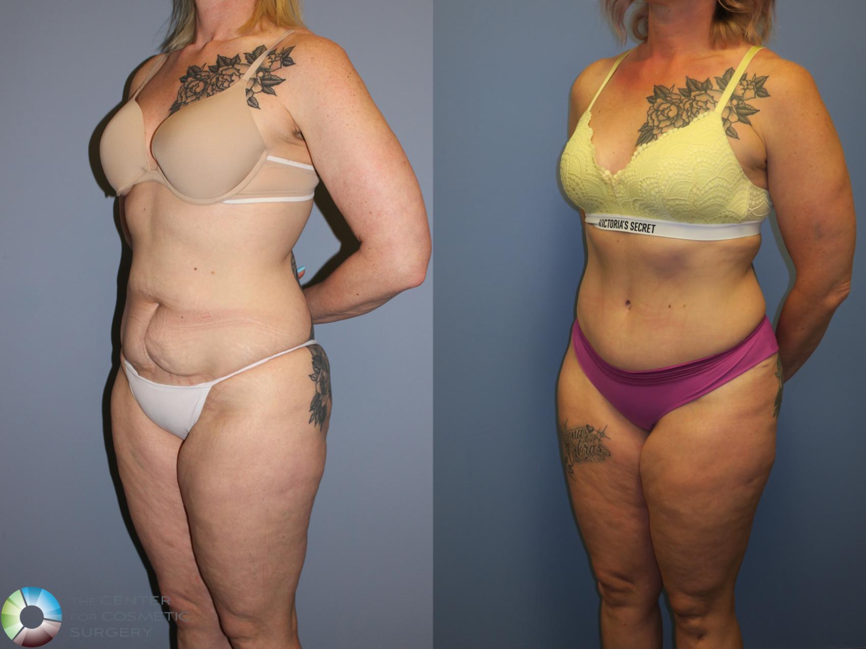 Before & After Tummy Tuck Case 11403 Left Oblique in Denver, CO