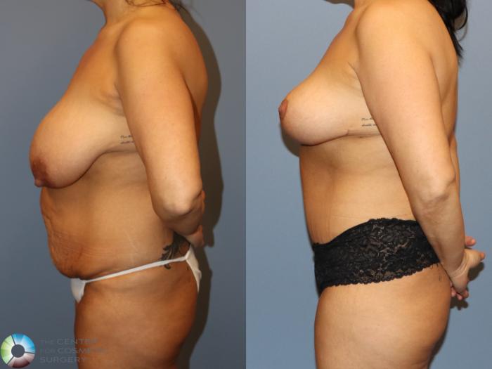 Before & After Power-Assisted Liposuction Case 12159 Left Side in Denver and Colorado Springs, CO