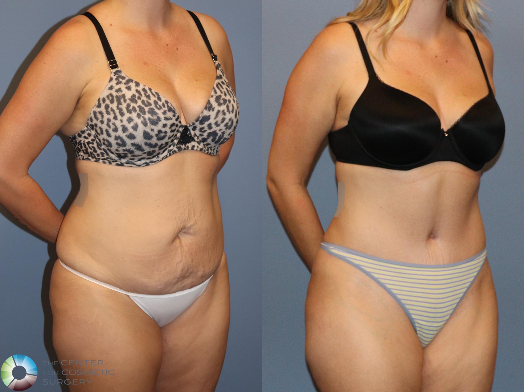 Before & After Tummy Tuck Case 12170 Right Oblique in Denver and Colorado Springs, CO