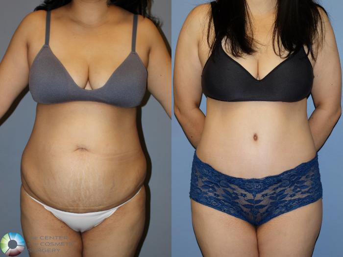 Before & After Power-Assisted Liposuction Case 12173 Front in Denver and Colorado Springs, CO