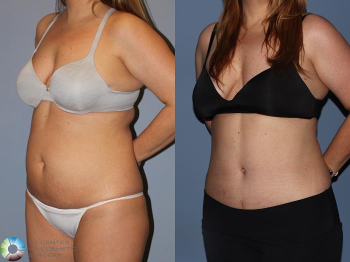 Before & After Power-Assisted Liposuction Case 12185 Left Oblique in Denver and Colorado Springs, CO