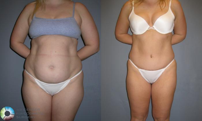 Before & After Power-assisted Liposuction Case 192 View #1 in Denver, CO