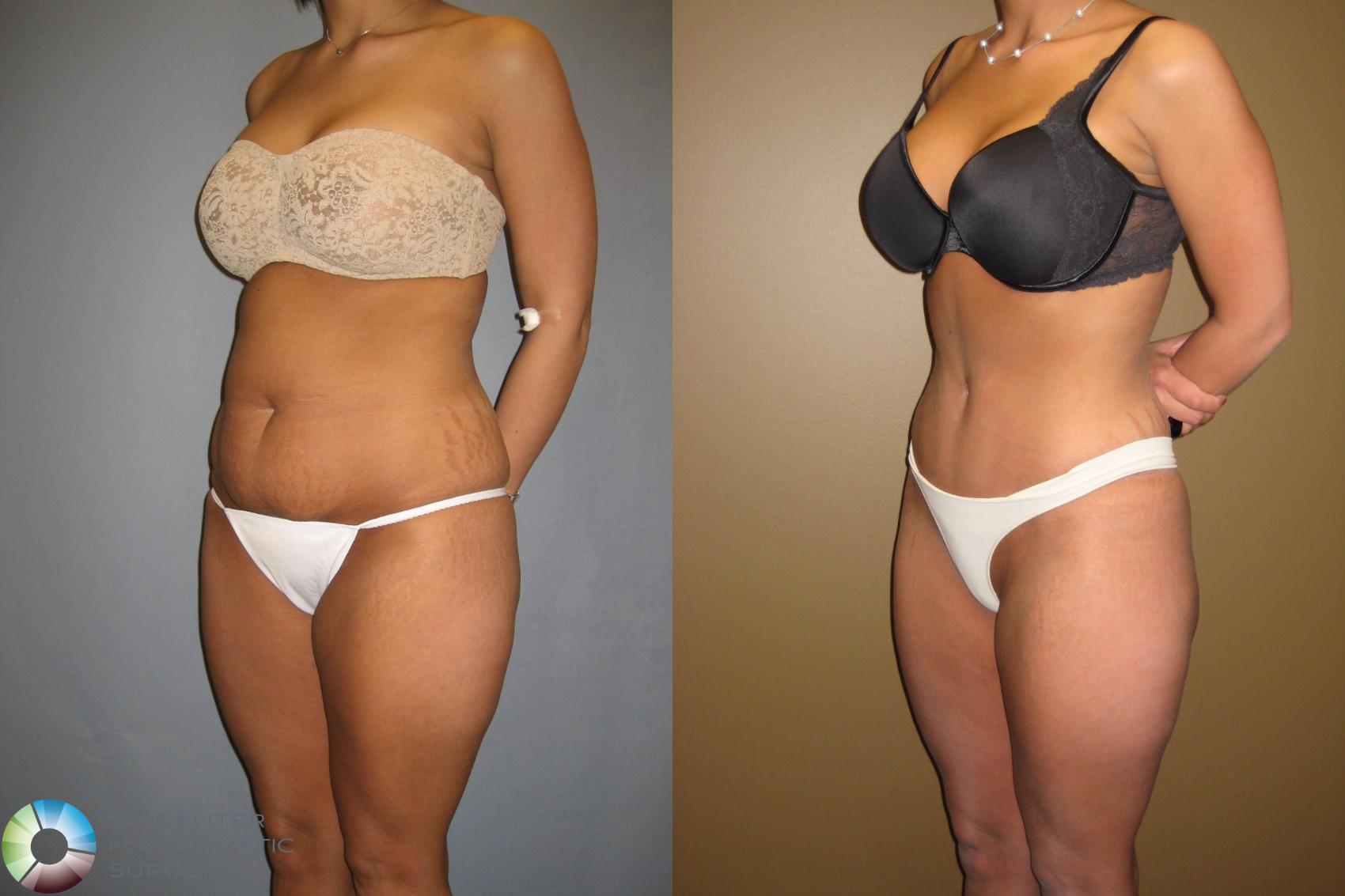 Before & After Tummy Tuck Case 302 View #1 in Denver, CO