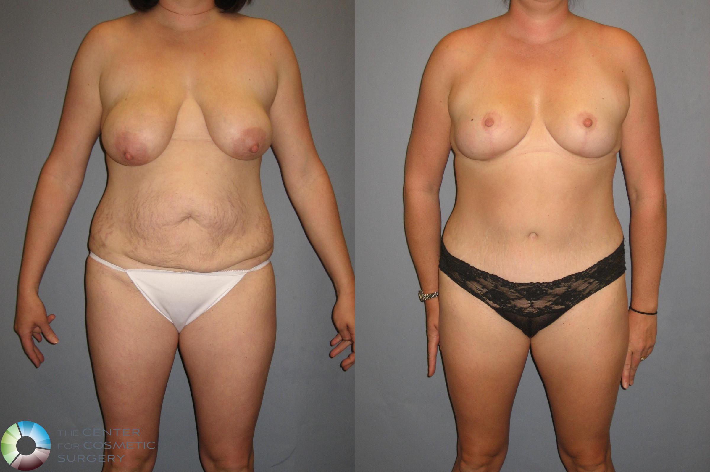 Tummy Tuck Case 324 Before & After View #1 | Golden, CO | The Center for Cosmetic Surgery