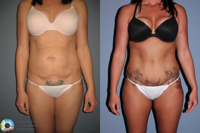 Before & After Liposuction Case 490 View #1 in Denver, CO