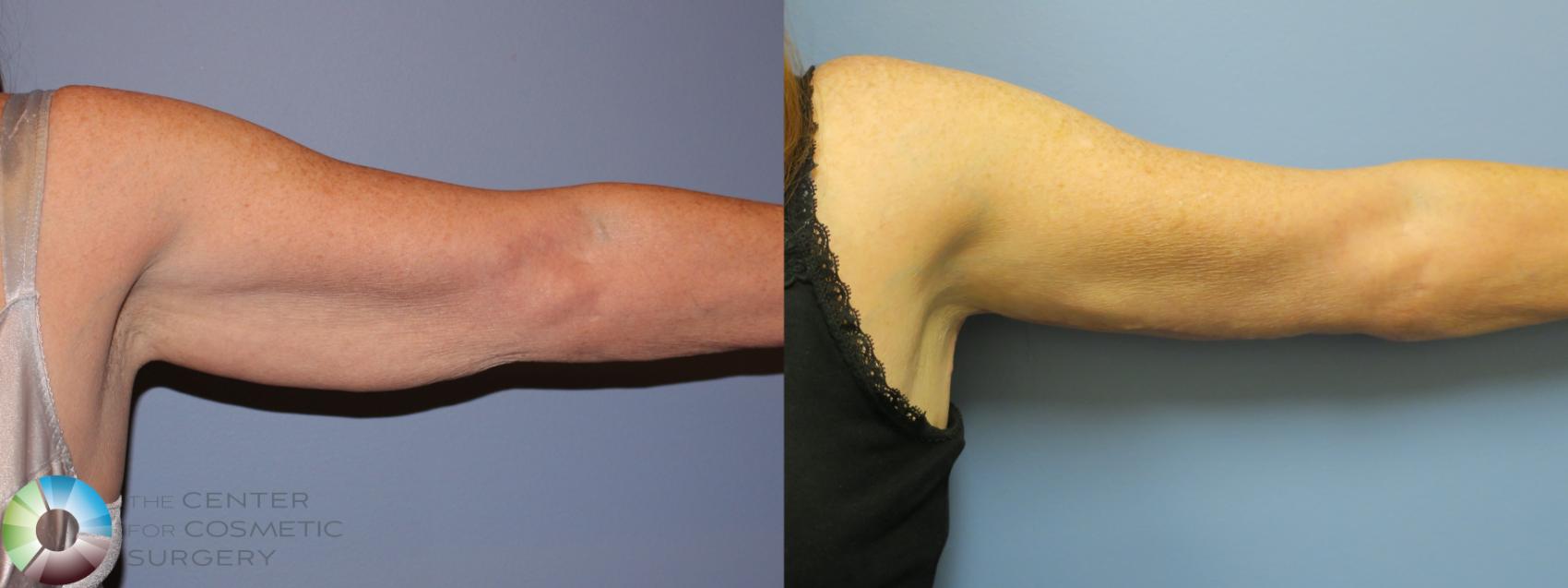 Denver Brachioplasty Arm Lift