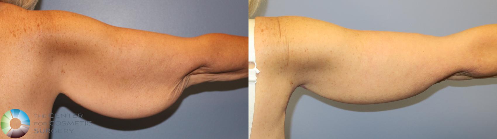 Before & After Arm Lift Case 11281 Back in Denver and Colorado Springs, CO