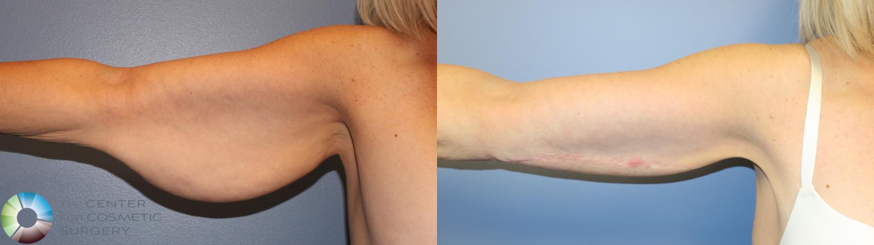 Denver Arm Lift Brachioplasty