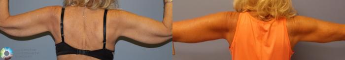 Before & After Arm Lift Case 11506 Back in Denver and Colorado Springs, CO