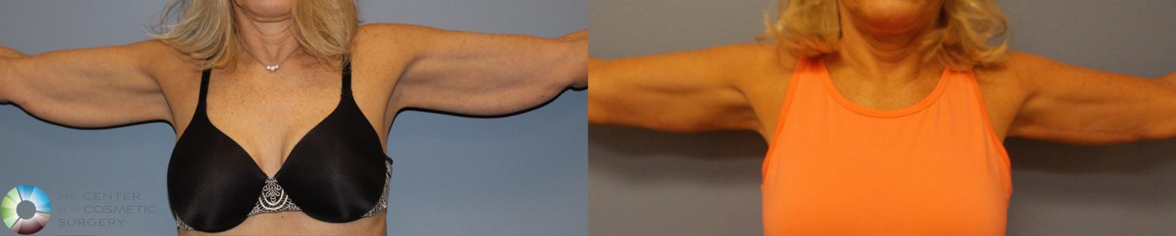 Best Denver Arm Lift Brachioplasty