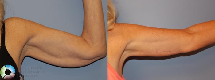 Before & After Arm Lift Case 11506 Left Anterior in Denver and Colorado Springs, CO