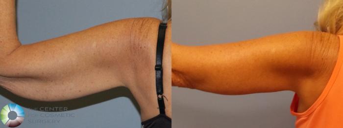Before & After Arm Lift Case 11506 Left Posterior in Denver and Colorado Springs, CO