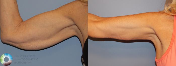 Before & After Arm Lift Case 11506 Right Anterior in Denver and Colorado Springs, CO