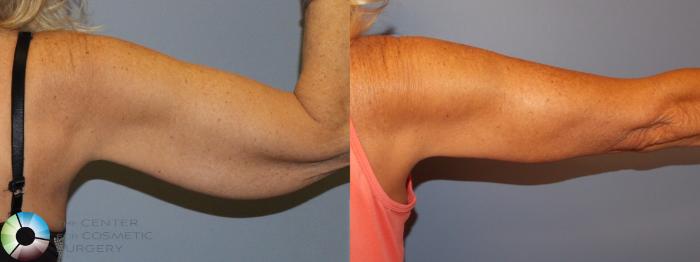 Before & After Arm Lift Case 11506 Right Posterior in Denver and Colorado Springs, CO