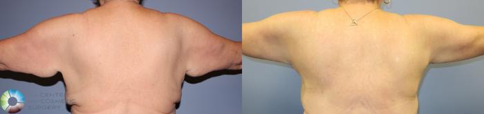 Before & After Arm Lift Case 11507 Back in Denver and Colorado Springs, CO