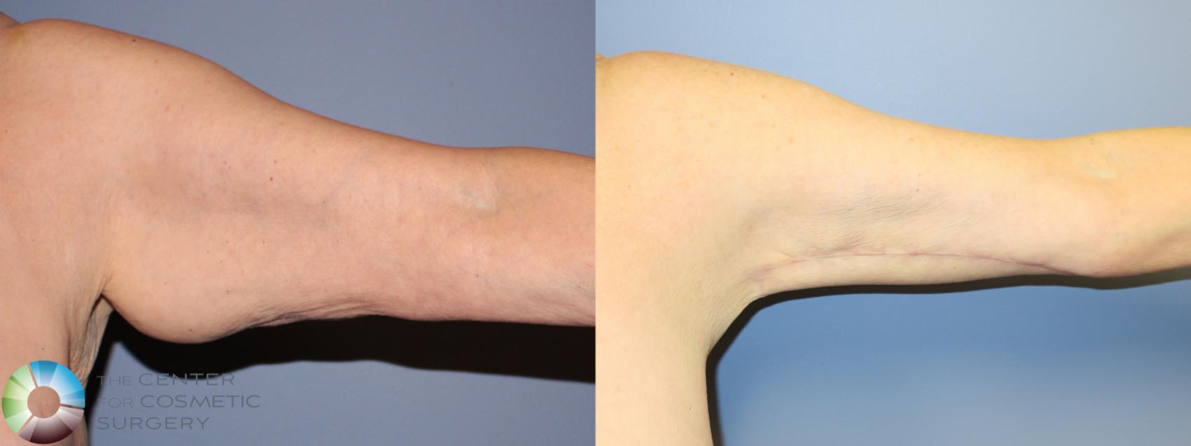 Best Denver Arm Lift Brachioplasty