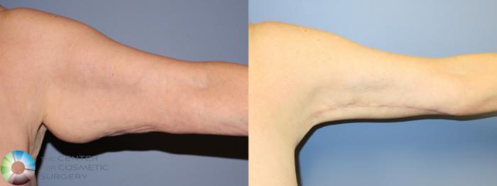 Before & After Arm Lift Case 11507 Left Anterior in Denver and Colorado Springs, CO