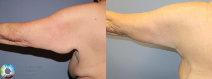 Before & After Arm Lift Case 11507 Left Posterior in Denver and Colorado Springs, CO