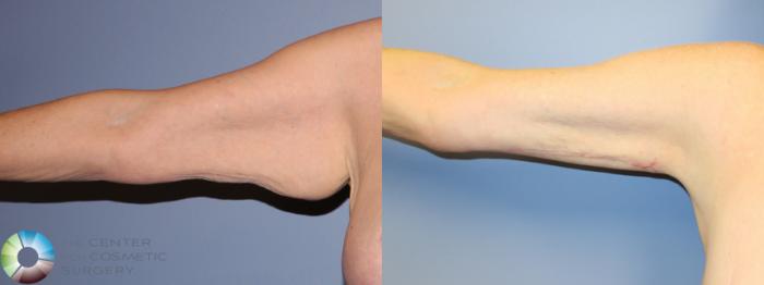 Before & After Arm Lift Case 11507 Right Anterior in Denver and Colorado Springs, CO