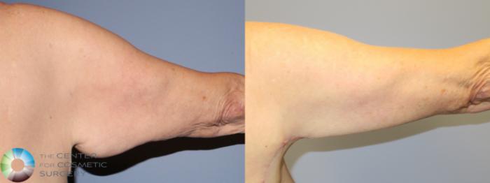 Before & After Arm Lift Case 11507 Right Posterior in Denver and Colorado Springs, CO
