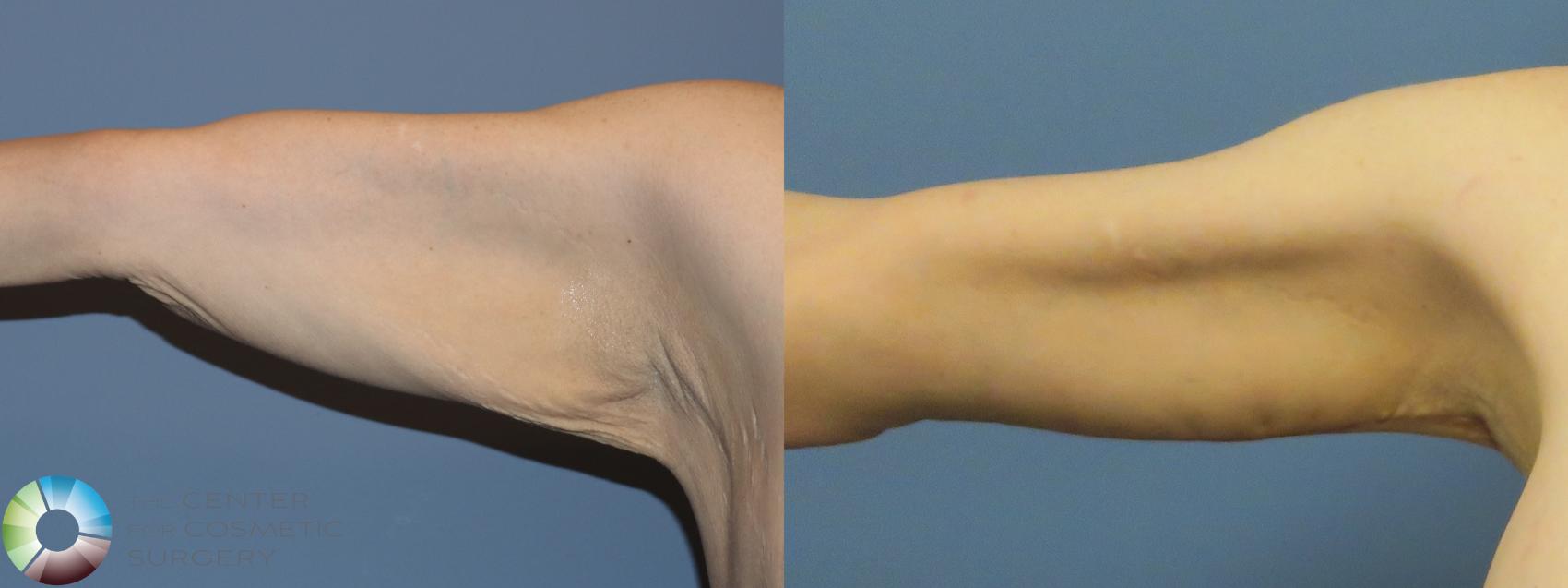 Before & After Arm Lift Case 11775 Front in Denver and Colorado Springs, CO
