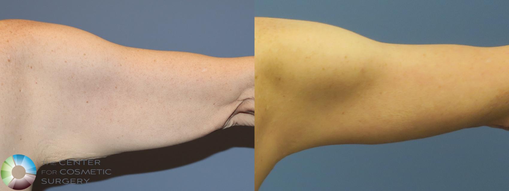 Before & After Arm Lift Case 11775 Right Posterior in Denver and Colorado Springs, CO