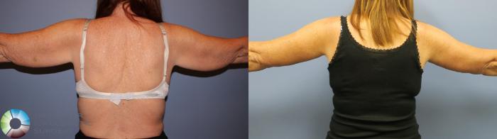 Before & After Arm Lift Case 11776 Back in Denver and Colorado Springs, CO