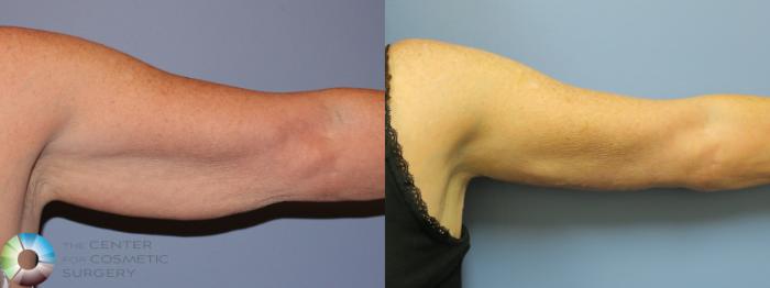 Before & After Arm Lift Case 11776 Left Side in Denver and Colorado Springs, CO