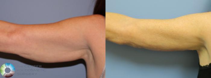 Before & After Arm Lift Case 11776 Right Side in Denver and Colorado Springs, CO