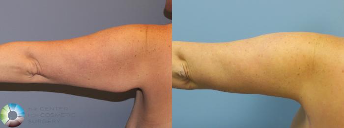 Before & After Arm Lift Case 11777 Left Posterior View in Golden, CO