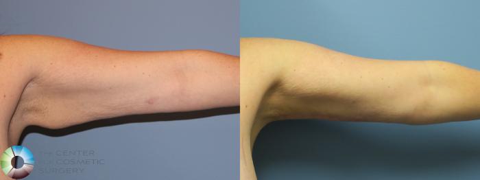 Before & After Arm Lift Case 11777 Left Side View in Golden, CO