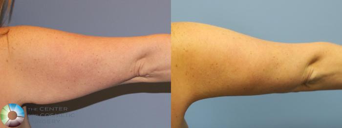 Before & After Arm Lift Case 11777 Right Posterior View in Golden, CO