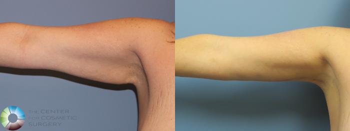Before & After Arm Lift Case 11777 Right Side View in Golden, CO