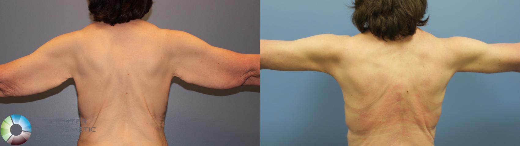 Before & After Arm Lift Case 11778 Back in Denver and Colorado Springs, CO
