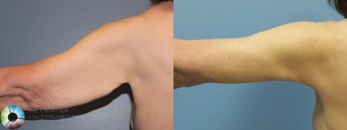 Before & After Arm Lift Case 11778 Left Posterior View in Golden, CO