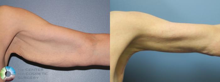 Before & After Arm Lift Case 11778 Left Side View in Golden, CO