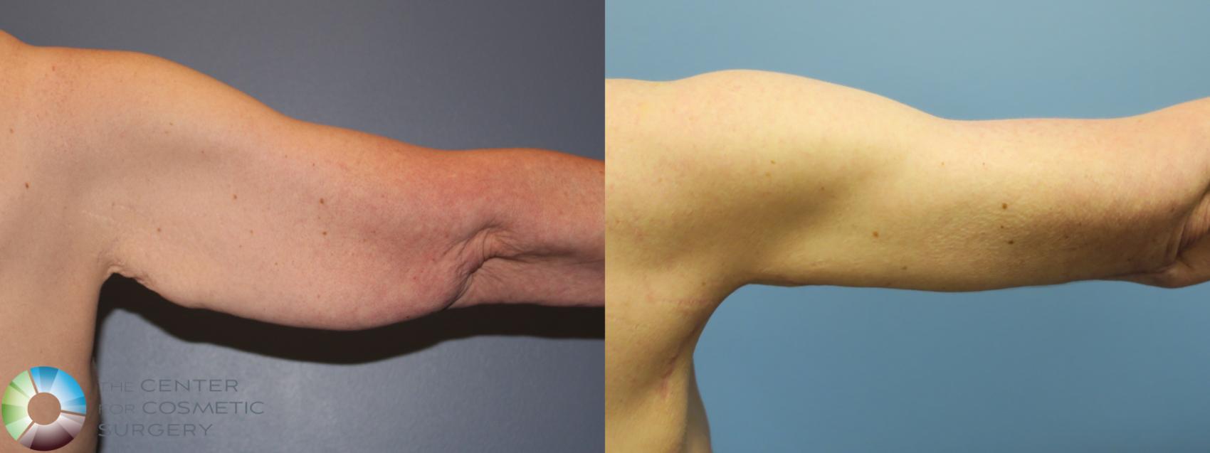 Before & After Arm Lift Case 11778 Right Posterior View in Golden, CO