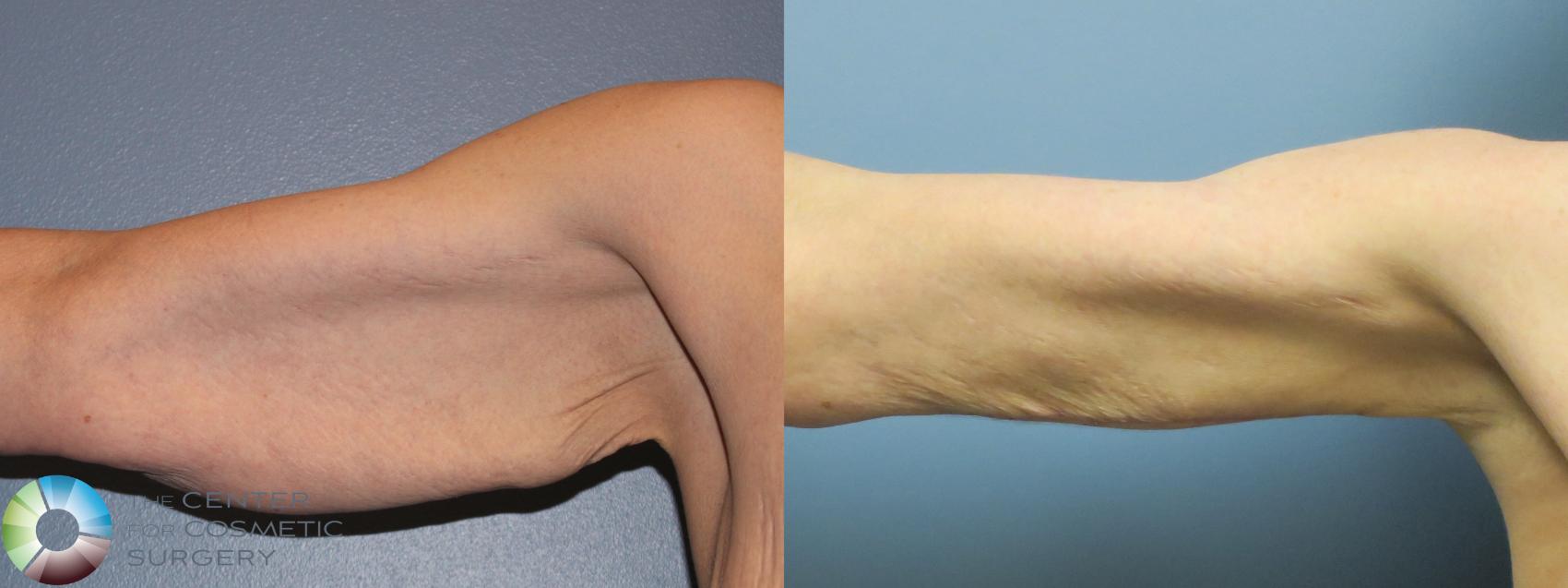 Before & After Arm Lift Case 11778 Right Side in Denver and Colorado Springs, CO