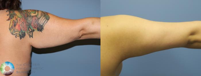 Best Denver Arm Lift Brachioplasty