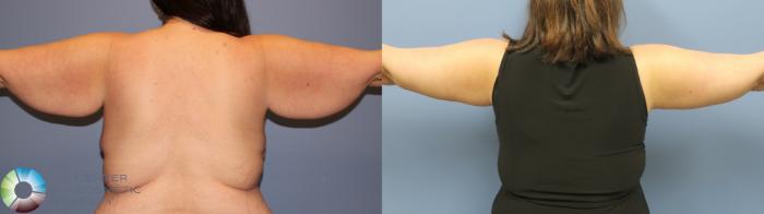 Before & After Arm Lift Case 11798 Back View in Golden, CO