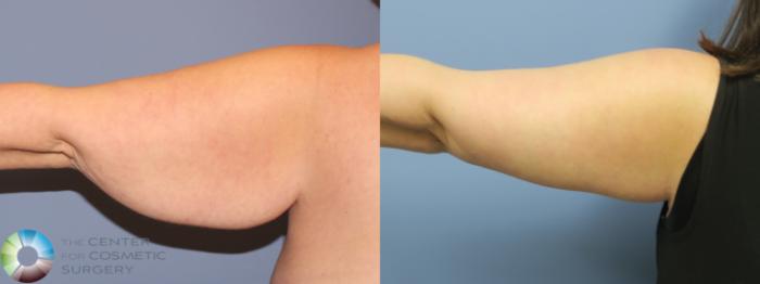 Before & After Arm Lift Case 11798 Left Posterior View in Golden, CO