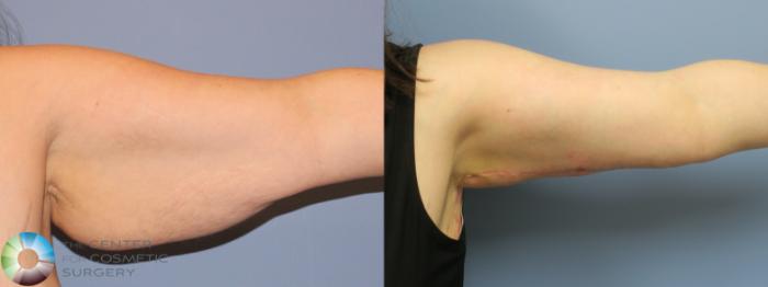 Before & After Arm Lift Case 11798 Left Side View in Golden, CO