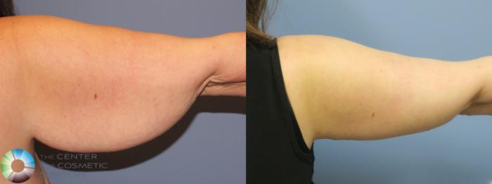 Before & After Arm Lift Case 11798 Right Posterior View in Golden, CO