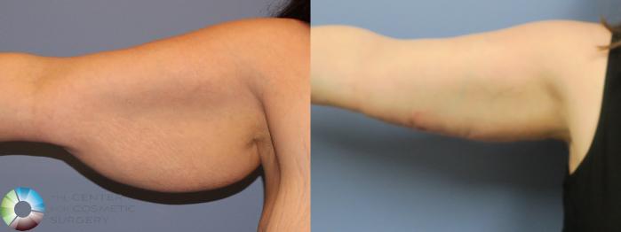 Before & After Arm Lift Case 11798 Right Side View in Golden, CO