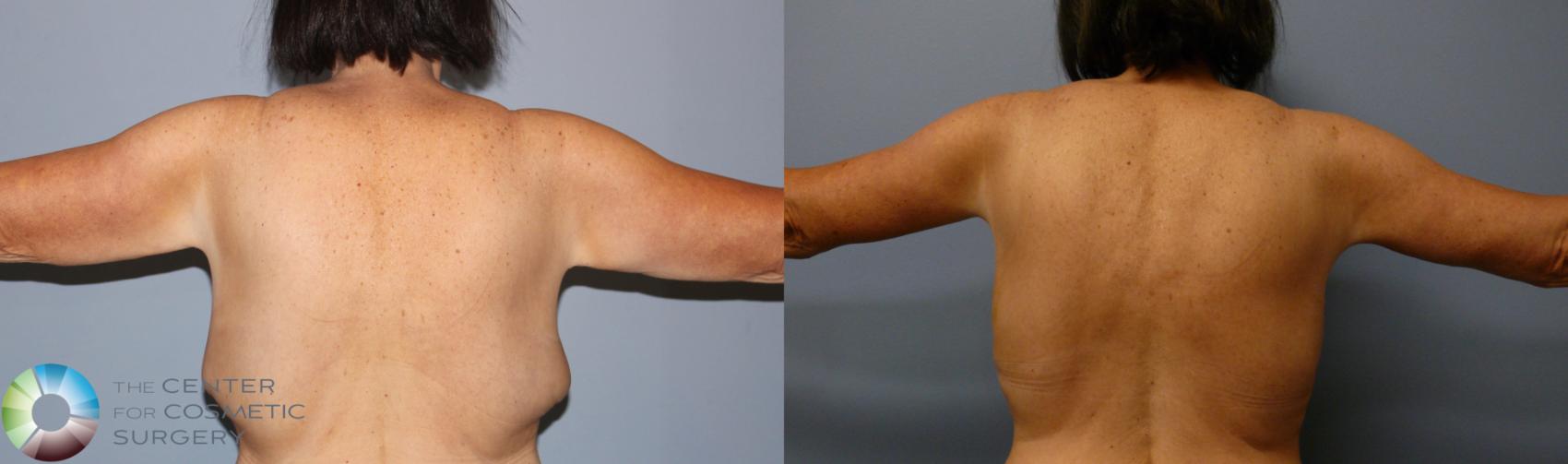 Before & After Arm Lift Case 11940 Back in Denver and Colorado Springs, CO